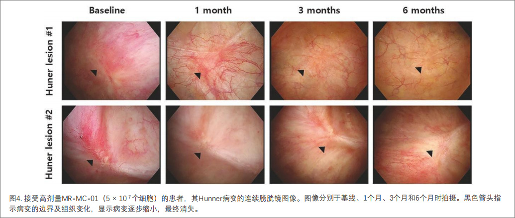 間質性膀胱炎臨床試驗 間質性膀胱炎臨床試驗