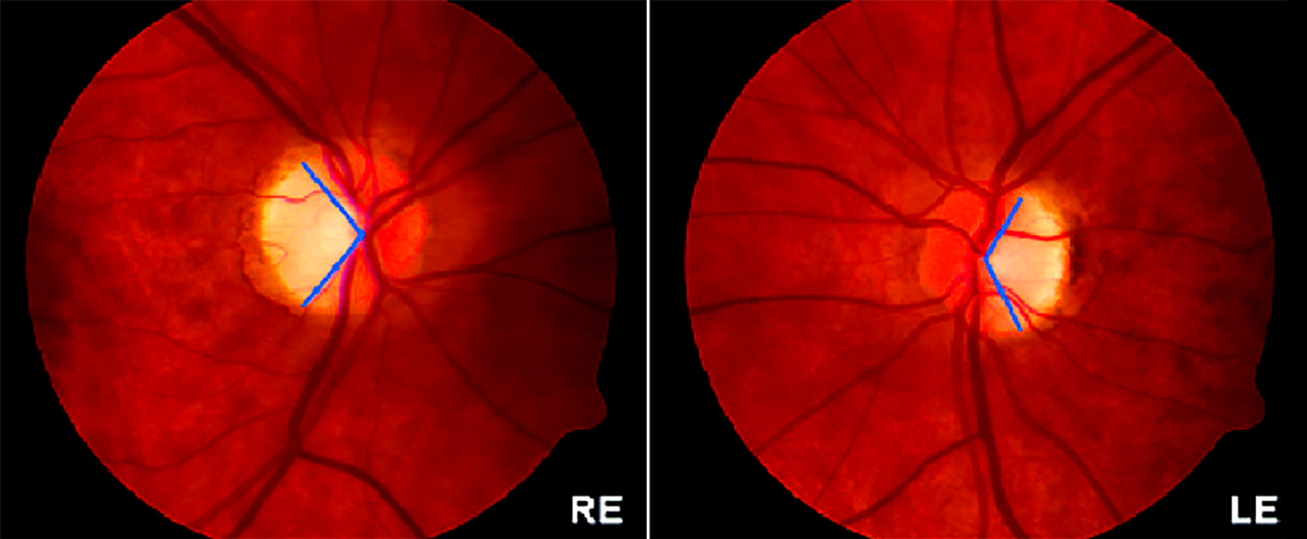 顯性視神經萎縮 顯性視神經萎縮