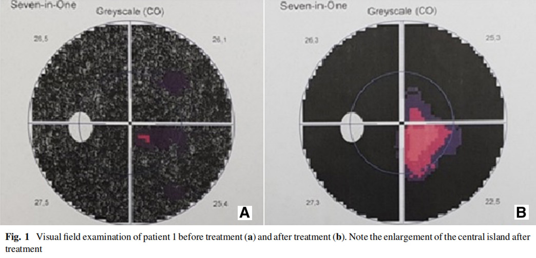 視神經萎縮臨床試驗 視神經萎縮臨床試驗