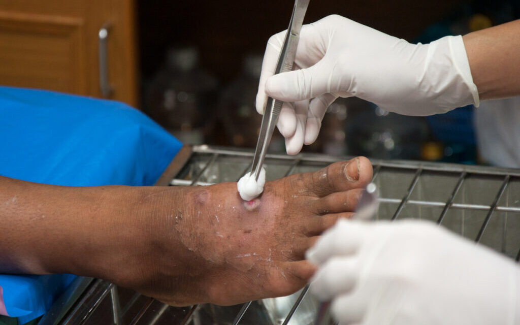 干細(xì)胞治療