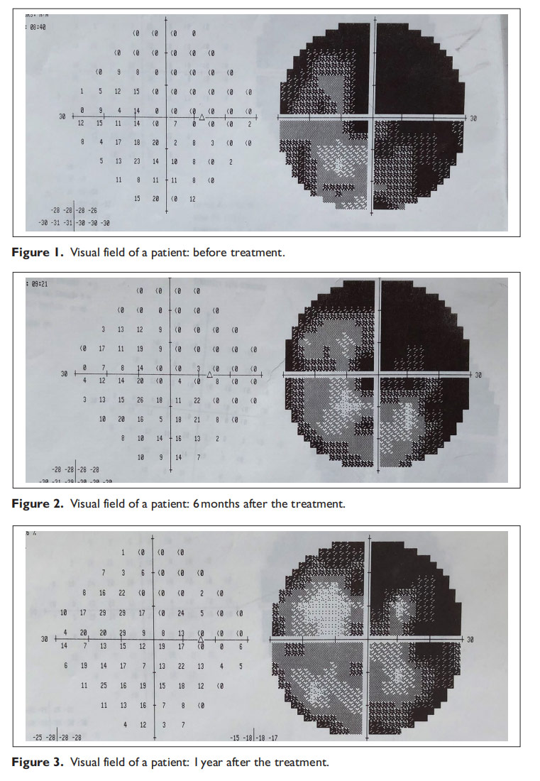 視神經萎縮臨床試驗 視神經萎縮臨床試驗