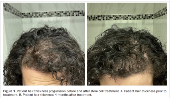 多囊卵巢綜合征臨床試驗(yàn) 多囊卵巢綜合征臨床試驗(yàn)