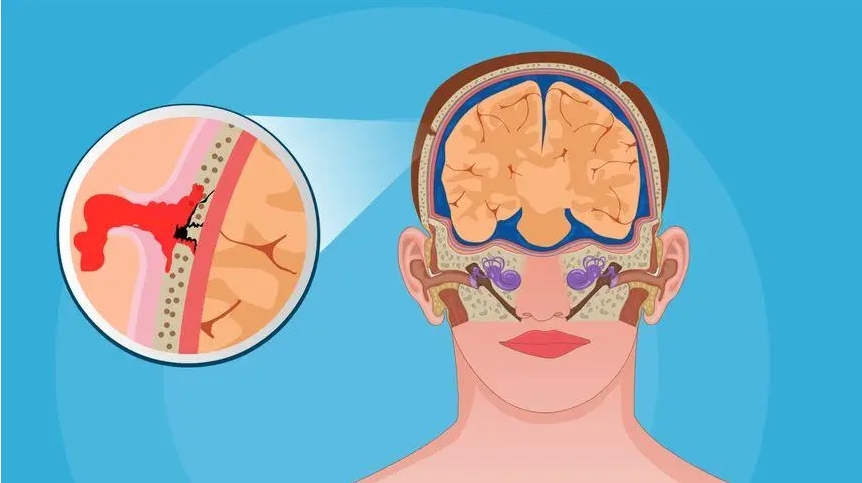 創傷性腦損傷 創傷性腦損傷