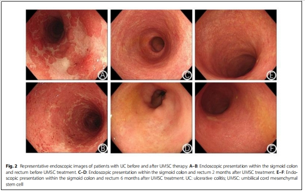 圖2:潰瘍性結腸炎患者接受UMSC治療前后內鏡檢查的典型圖像 圖2:潰瘍性結腸炎患者接受UMSC治療前后內鏡檢查的典型圖像