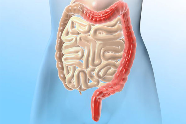 潰瘍性結腸炎新希望:干細胞移植2個月緩解率達7成,4成患者實現粘膜愈合 潰瘍性結腸炎新希望:干細胞移植2個月緩解率達7成,4成患者實現粘膜愈合