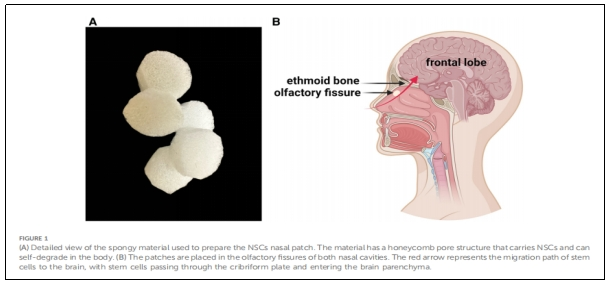 圖1:用于制備NSCs鼻貼片的海綿狀材料的詳細視圖。 圖1:用于制備NSCs鼻貼片的海綿狀材料的詳細視圖。