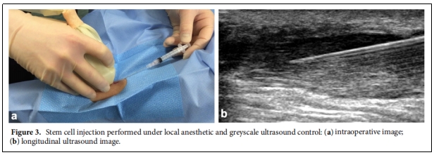圖3.在局部麻醉和灰階超聲控制下進行的干細胞注射