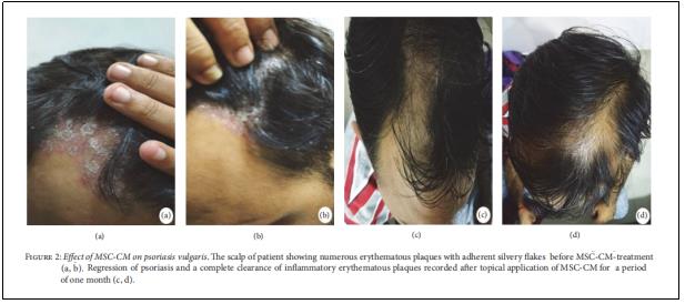 圖2:MSC-CM對尋常型銀屑病的影響。 圖2:MSC-CM對尋常型銀屑病的影響。