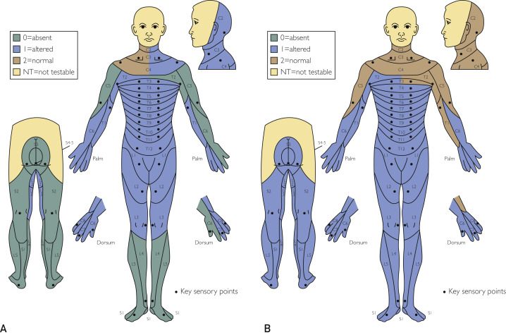 圖2：根據(jù)脊髓損傷神經(jīng)學分類國際標準，在基線（A）和 18 個月隨訪（B）時形成的皮節(jié)感覺評分。