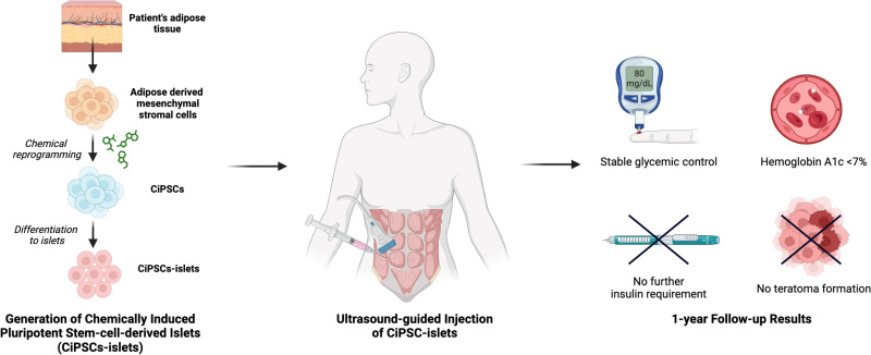圖示：?通過將患者脂肪組織提取的間充質(zhì)干細胞化學重編程為誘導多能干細胞并分化為胰島，再注射入腹直肌前鞘。