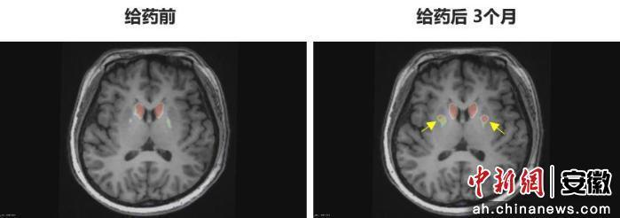圖為李女士 PET-DAT/MRI融合圖像術(shù)前與術(shù)后三個(gè)月對(duì)比。