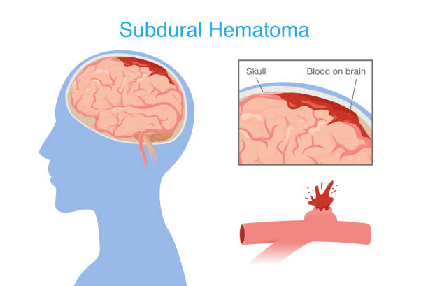 神經(jīng)干細胞移植治療腦出血的系統(tǒng)評價：NSC來源、輸送途徑、治療機制和早期臨床試驗