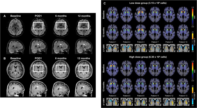圖6：代表性腦部MRI圖像以及A9-DPC移植后18F -FP-CIT攝取量的個體水平變化